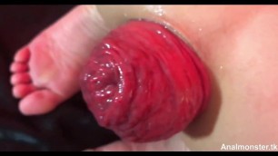 Huge anal prolapse ruined very closeup
